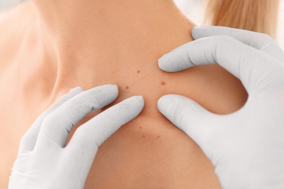 dermatoscopia