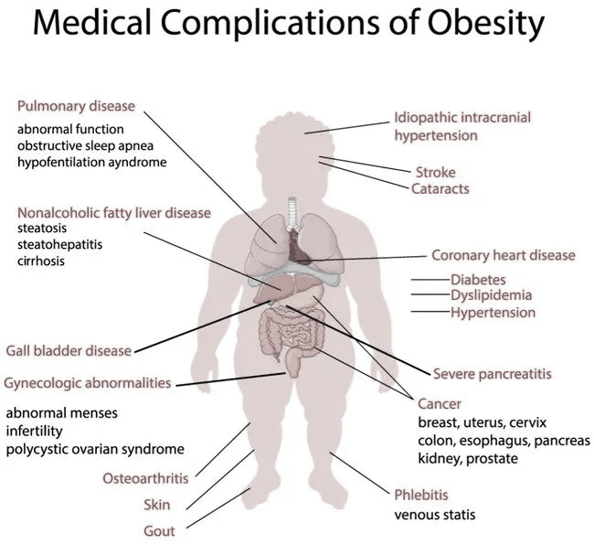 A diagram of the medical complications of obesity