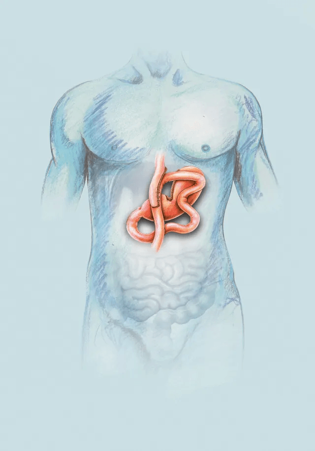 A drawing of a man 's stomach with a large intestine visible.