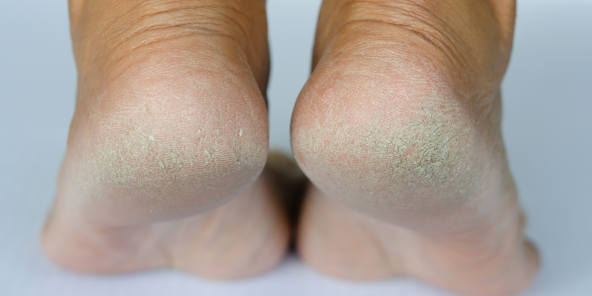 foot callus