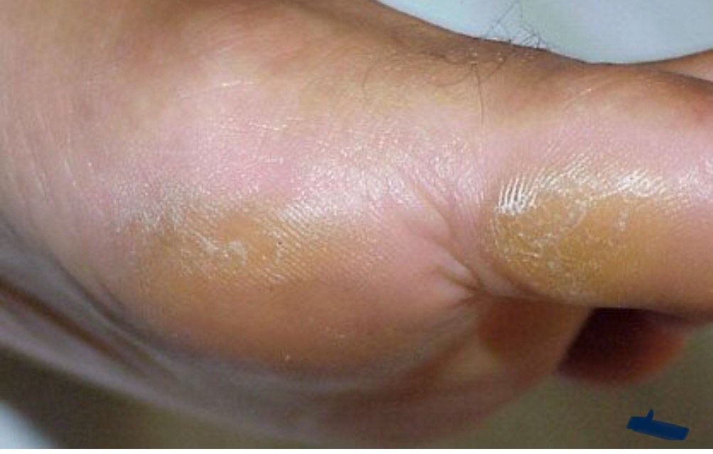 foot callus