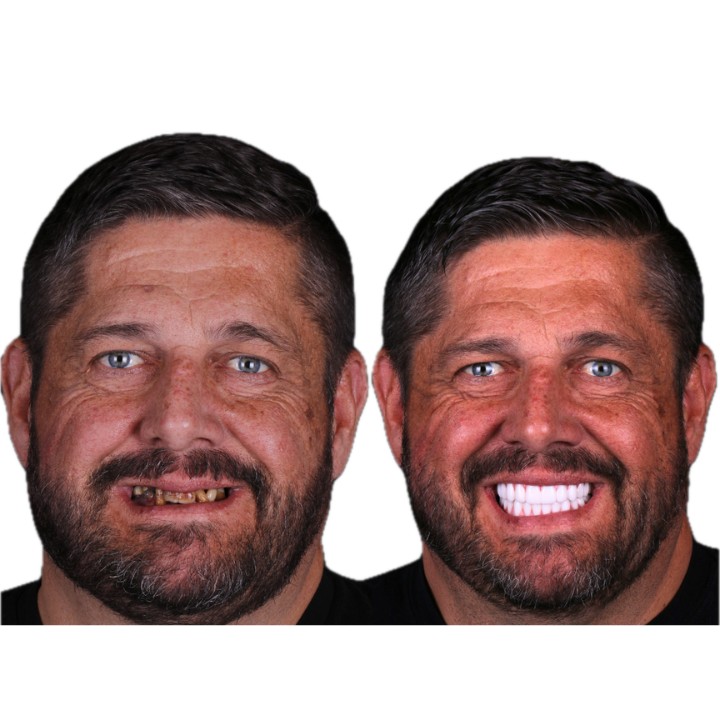 Side-by-side photo of a man before and after dental work. Before, missing teeth; after, bright white smile.