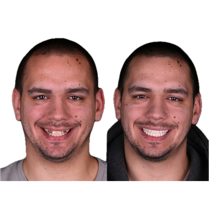 Side-by-side comparison of a person's smile before and after a dental procedure, showing improved teeth appearance.