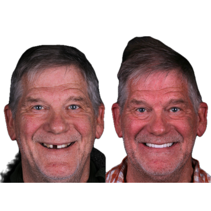 Before and after of a man with missing teeth, then with a full, white smile; wearing a button-up shirt.