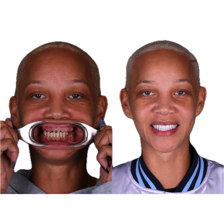 Side-by-side comparison: person's mouth with dental device, showing before and after teeth whitening.