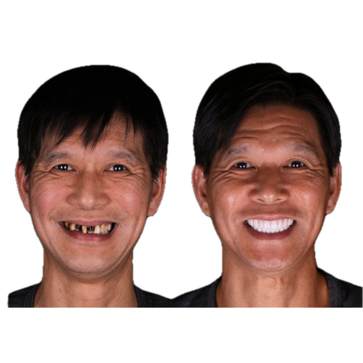 A man with missing teeth on the left smiles after receiving new teeth on the right.