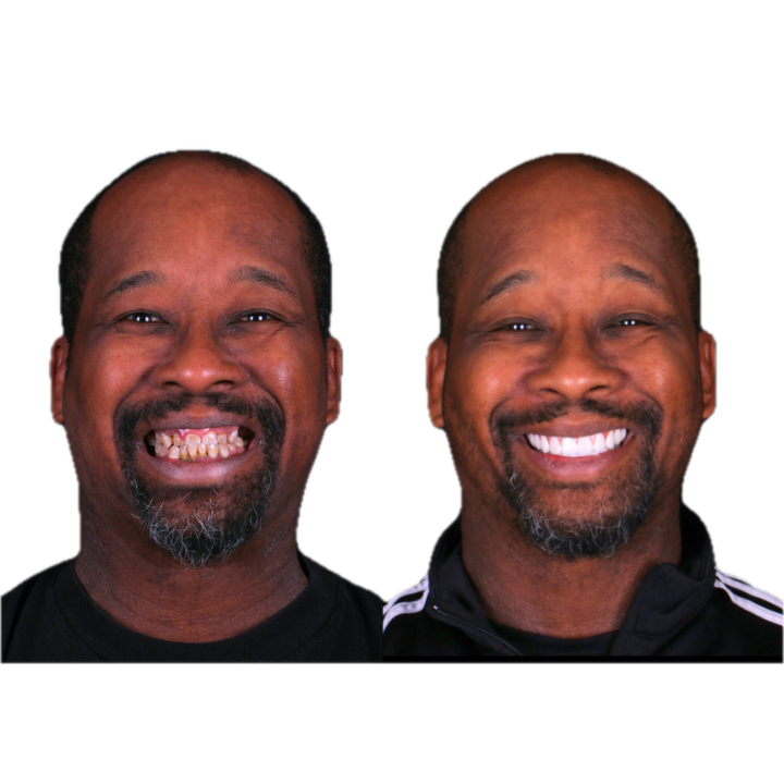 Before-and-after of a man's smile, showing stained teeth versus a bright, white smile.