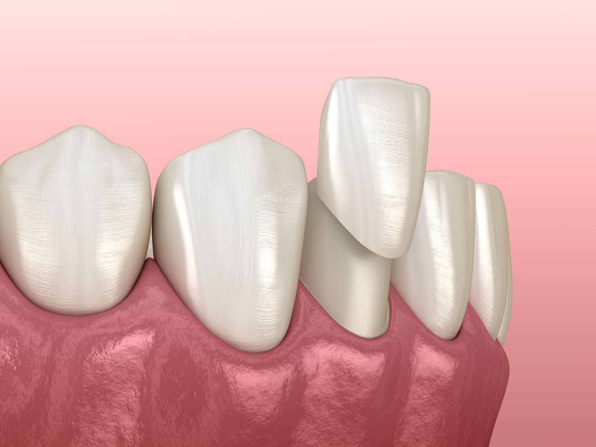 A computer generated image of a person 's teeth with dental crowns