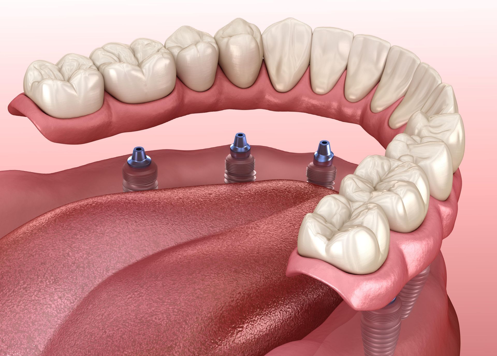 A computer generated image of a dental implant in a person 's mouth