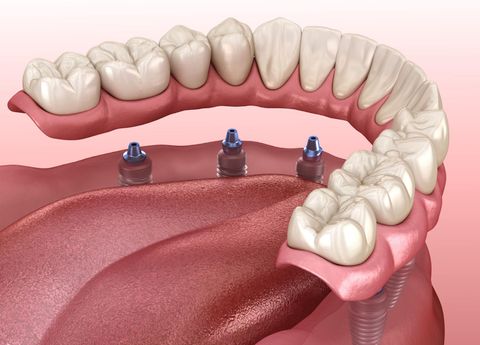 A computer generated image of a dental implant in a person 's mouth