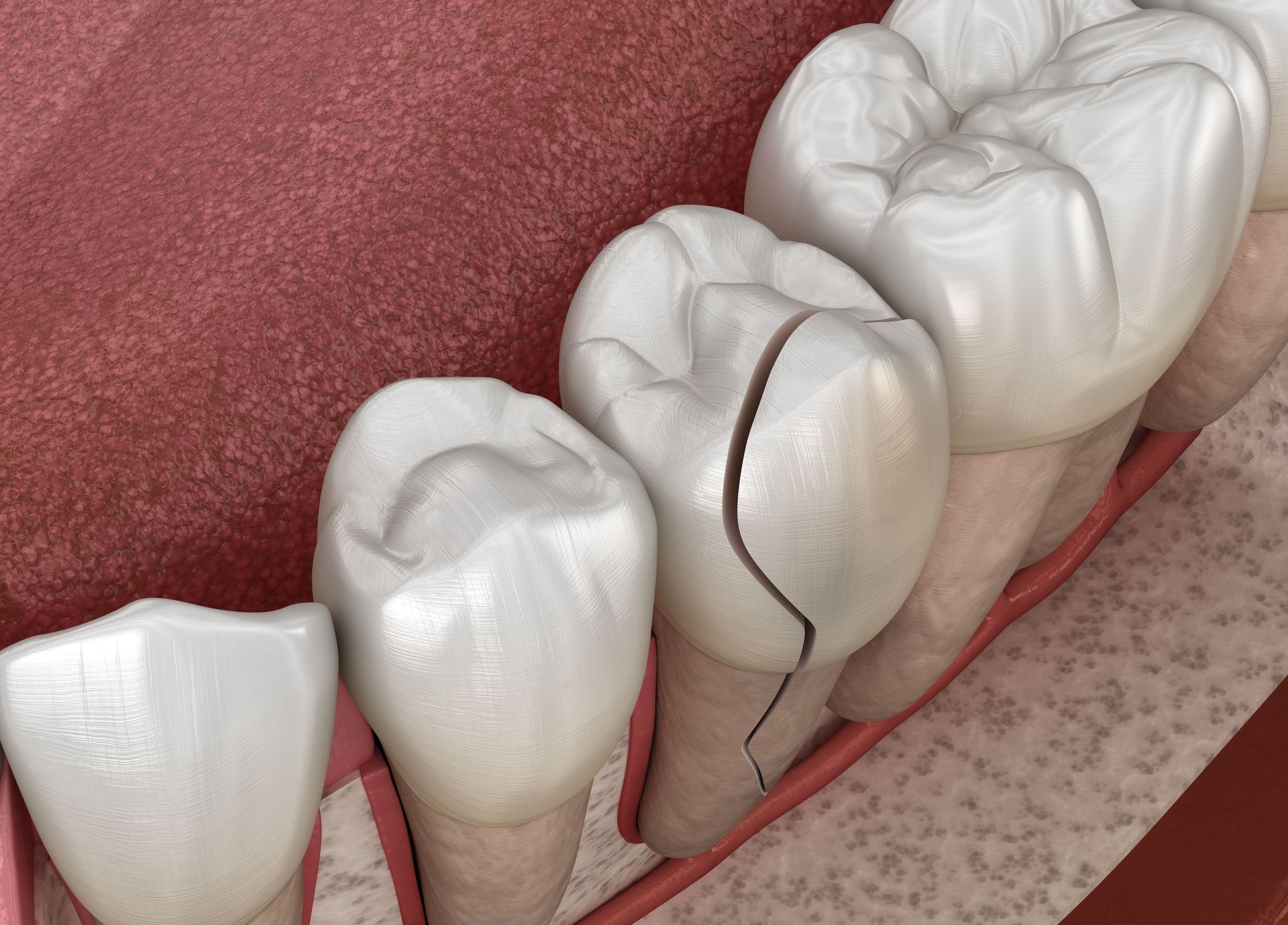 A computer generated image of a broken tooth in a mouth