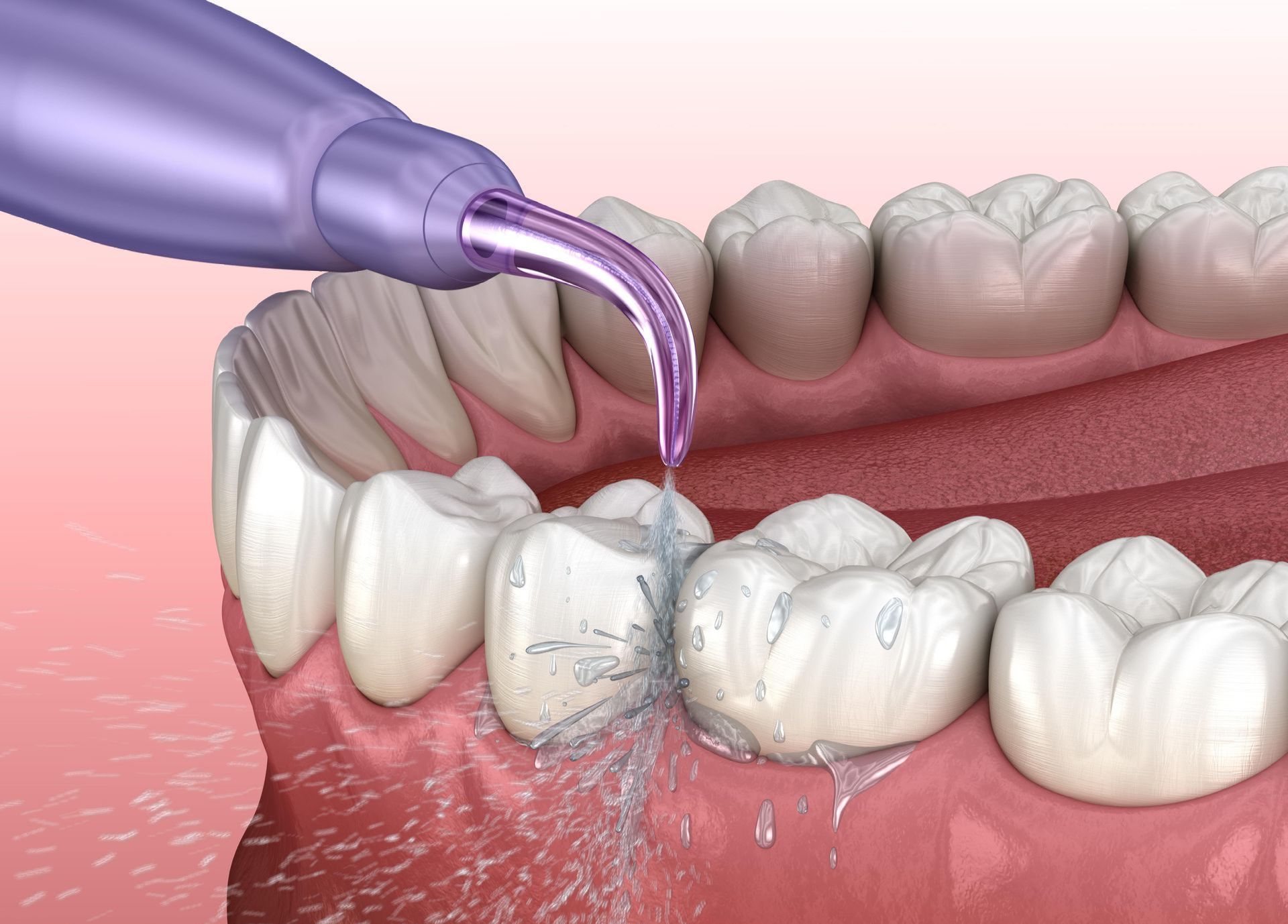 A close up of a person 's teeth being cleaned with a water flosser