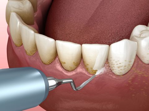 A computer generated image of a person 's teeth being cleaned