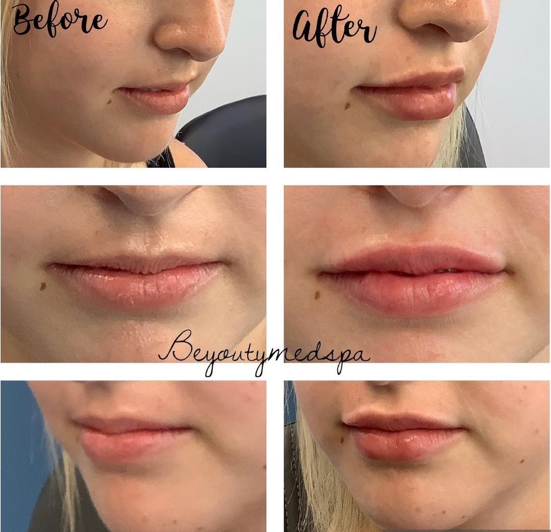 A before and after photo of a woman 's lips.