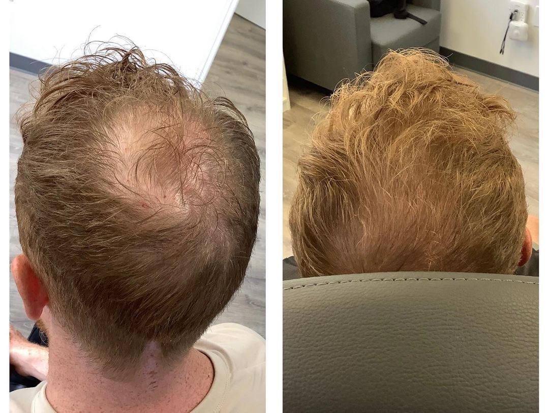 A before and after photo of a man 's hair growth.