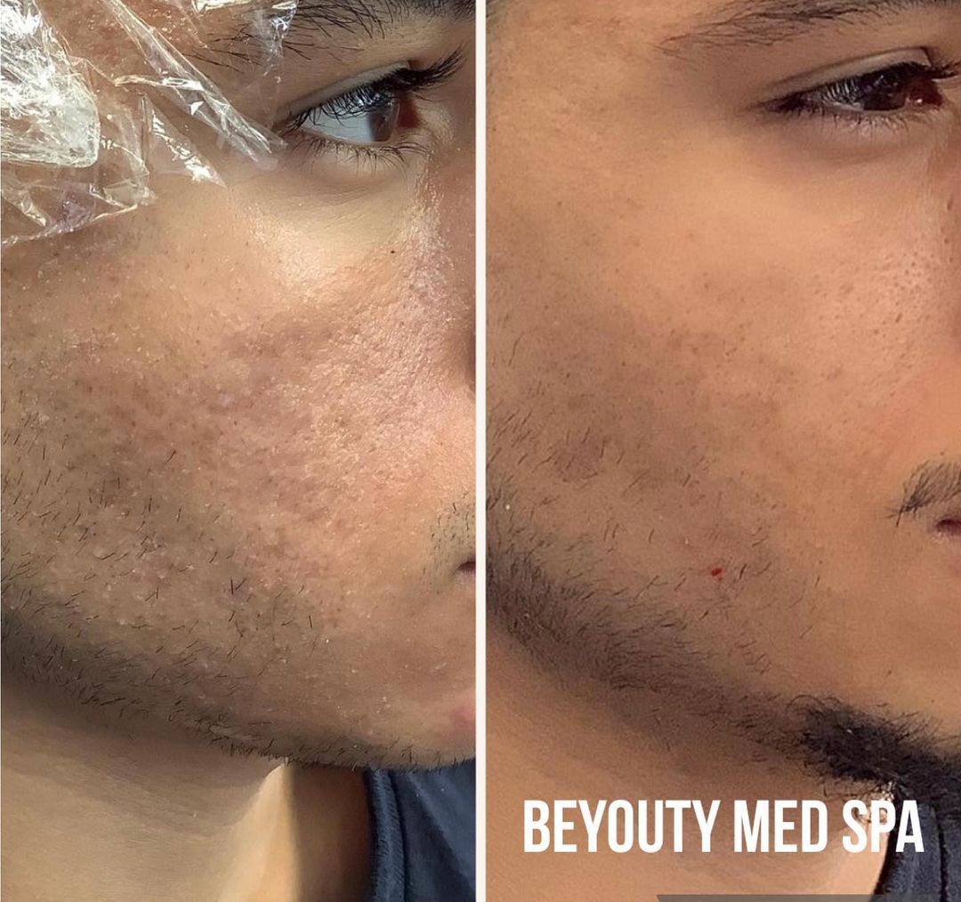 A before and after photo of a man 's face with plastic wrap on it.