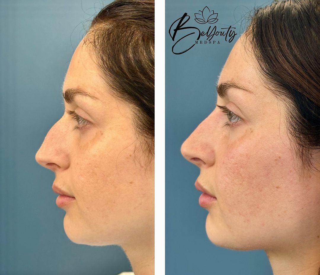 A before and after photo of a woman 's nose surgery.