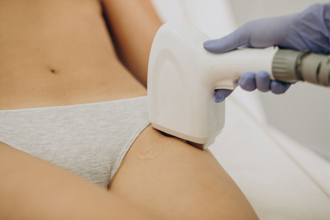 A woman getting laser hair removal at a med spa.