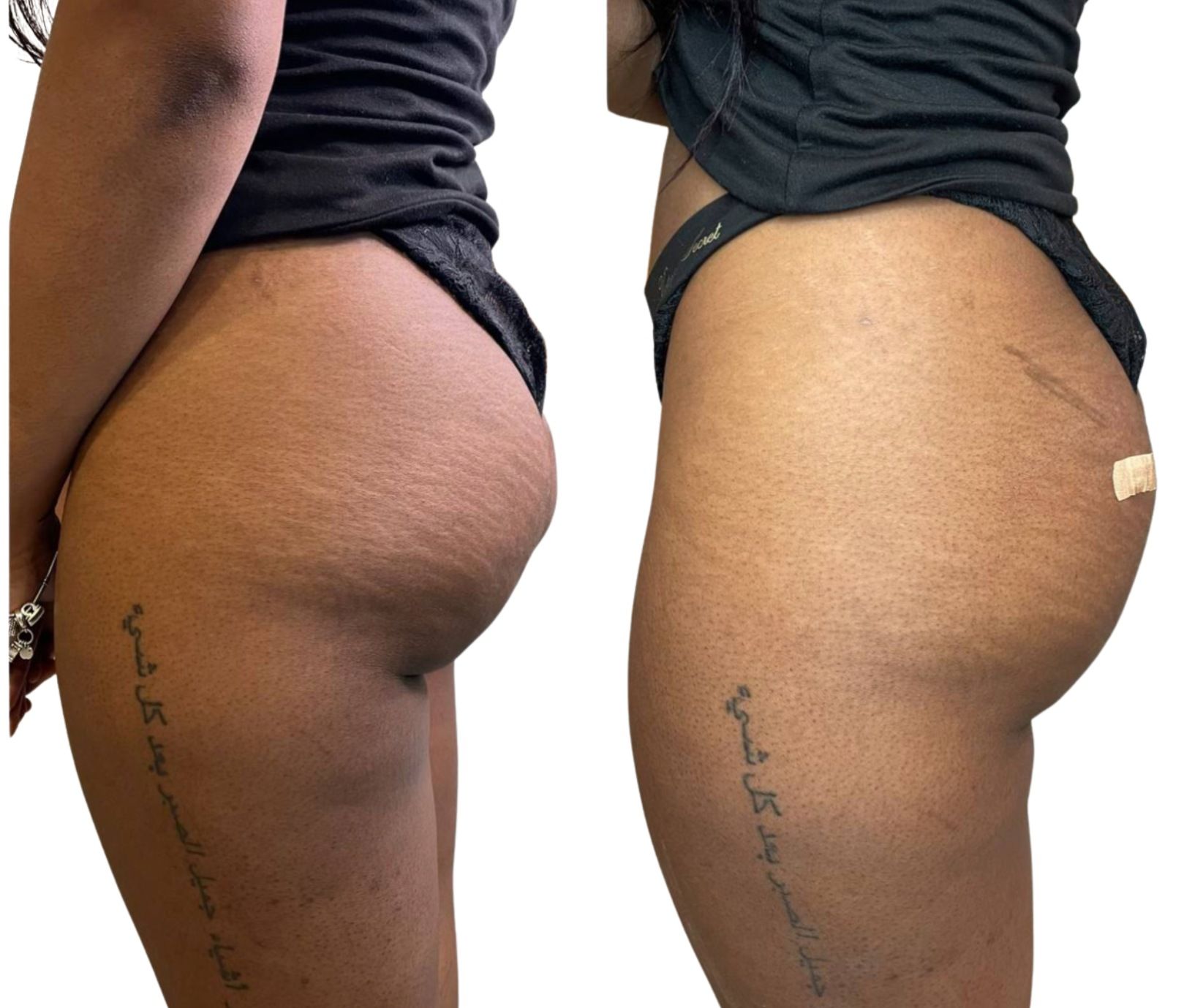 Comparison of a woman's buttocks before and after a procedure; skin tone is brown.