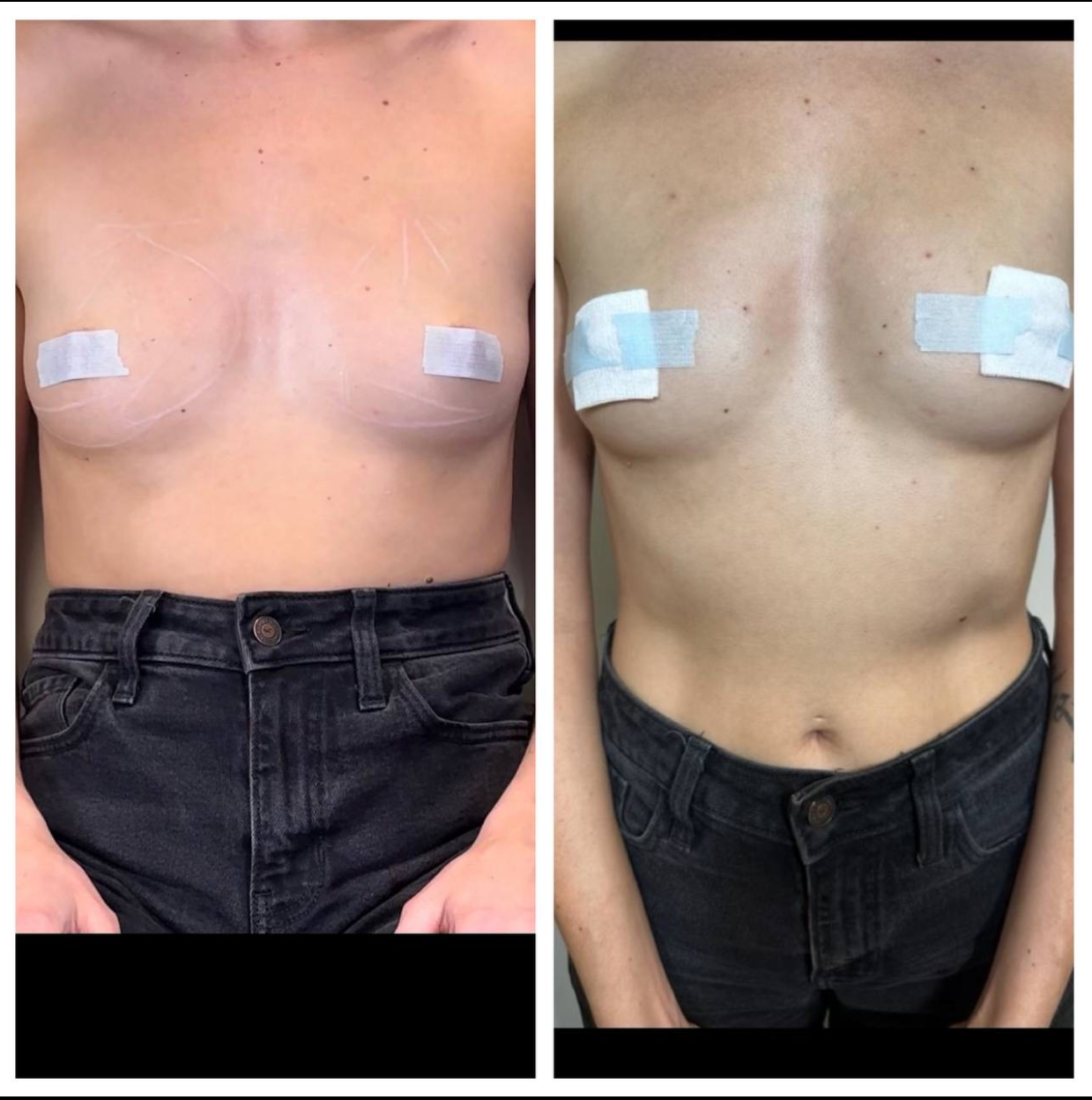 Two torso images showing post-surgery chest, wearing jeans and medical tape on nipples; the after result shows a flatter chest.