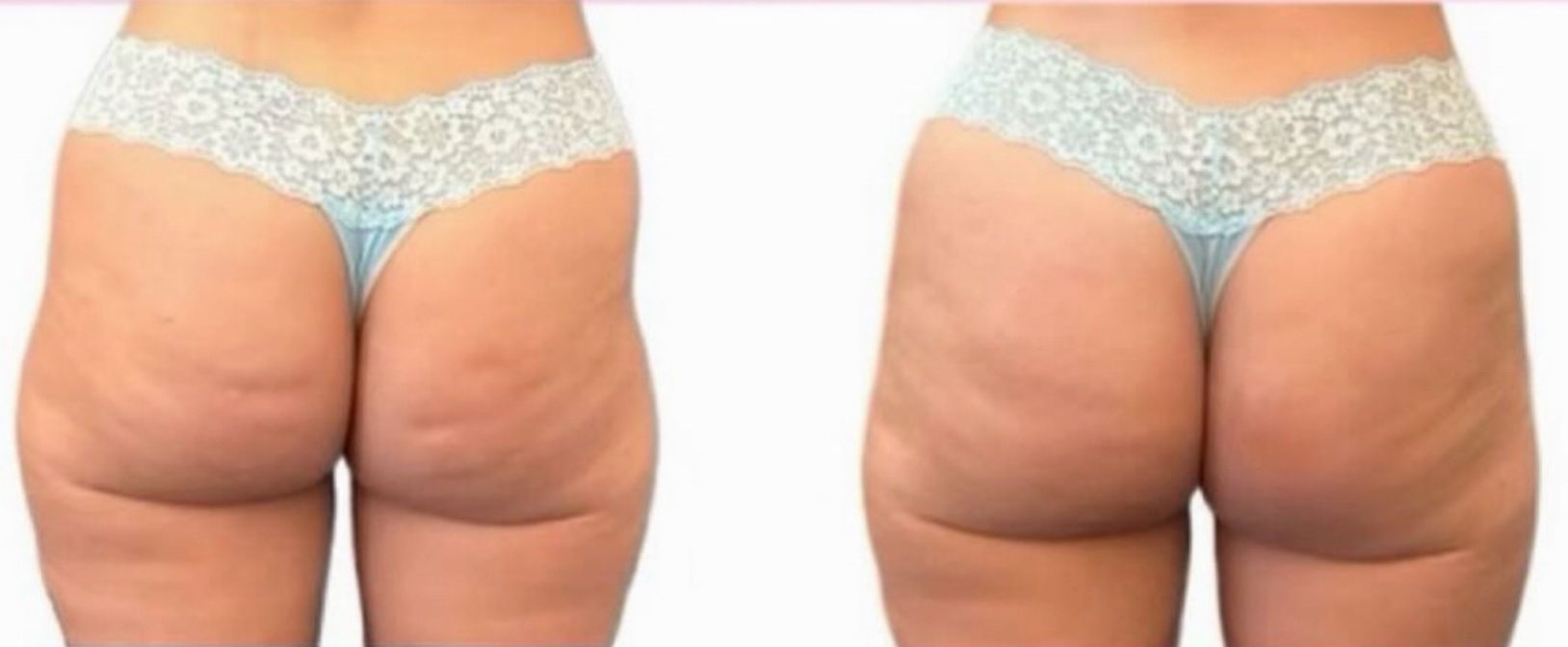 Before and after photo of a person's buttocks, showing a reduction in cellulite.