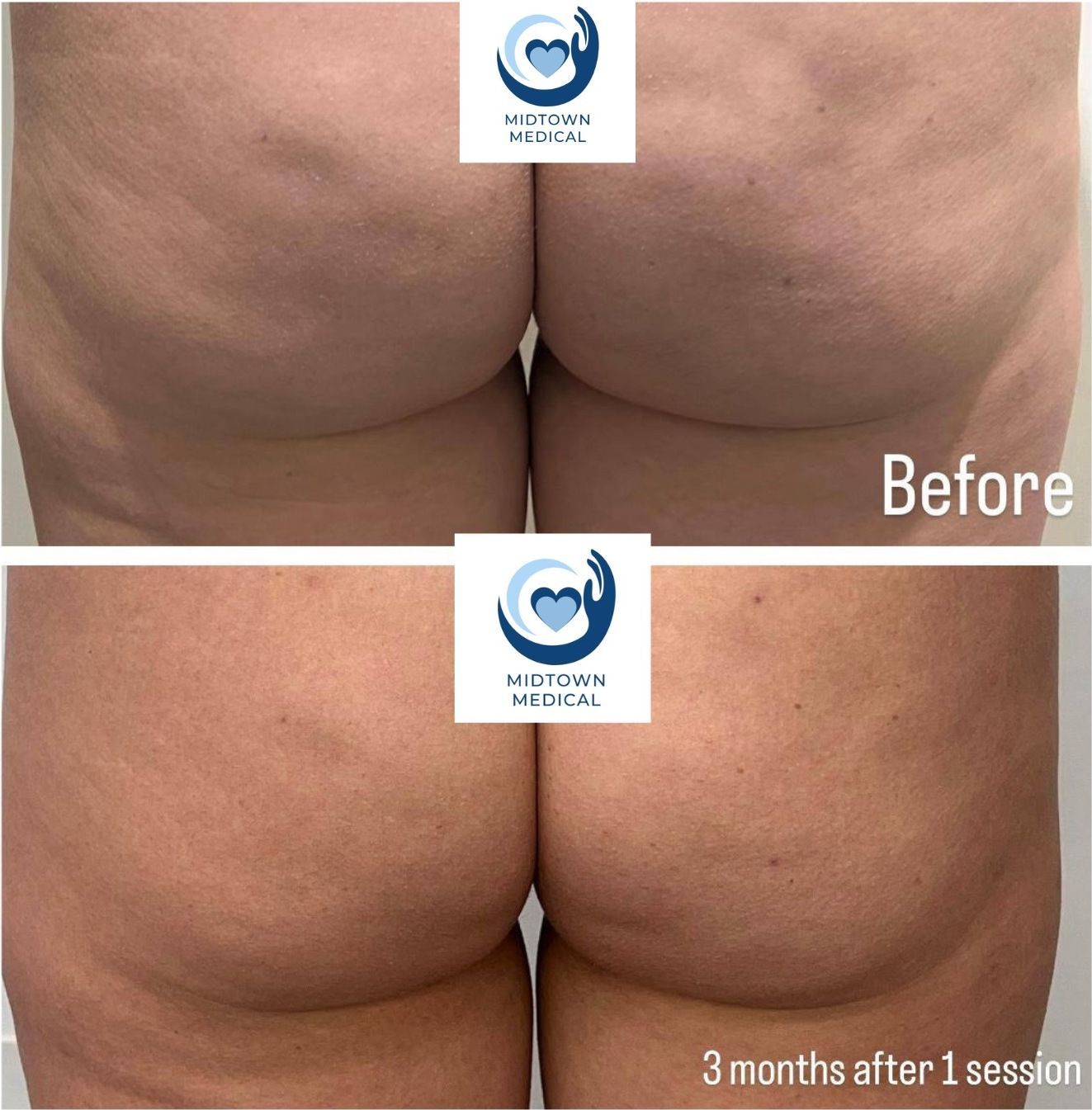 Before and after photos of a person's buttocks, showing a reduction in cellulite 3 months after a treatment.