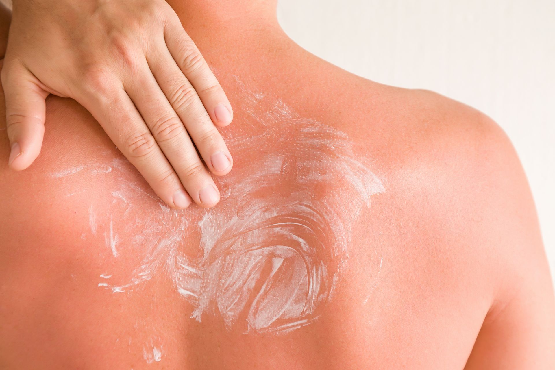 A person's hand applying white lotion to a sun-reddened upper back.