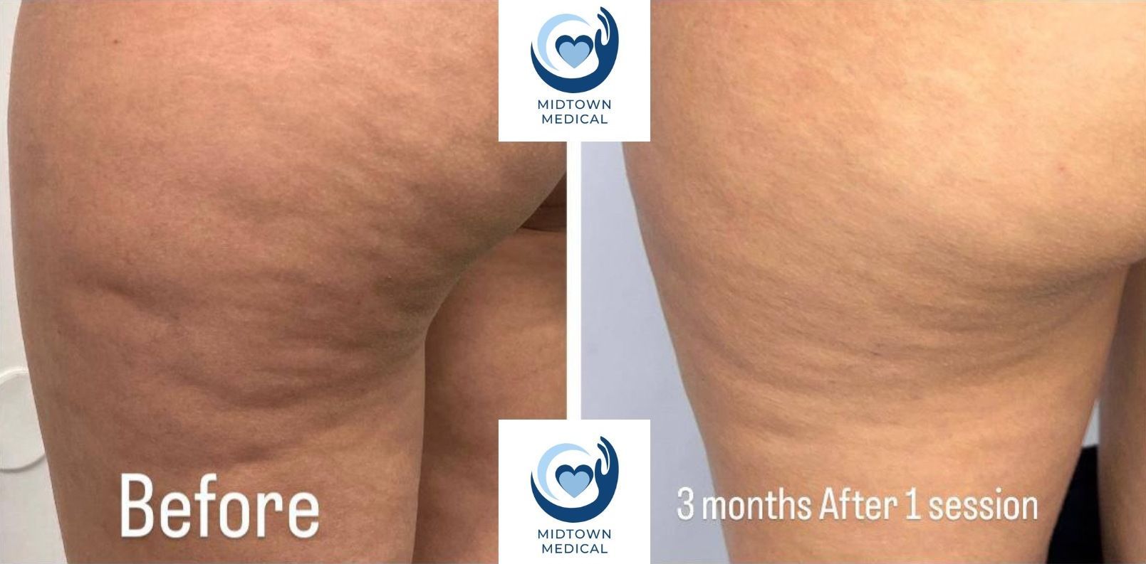 Side-by-side comparison of thighs: before and after cellulite treatment;