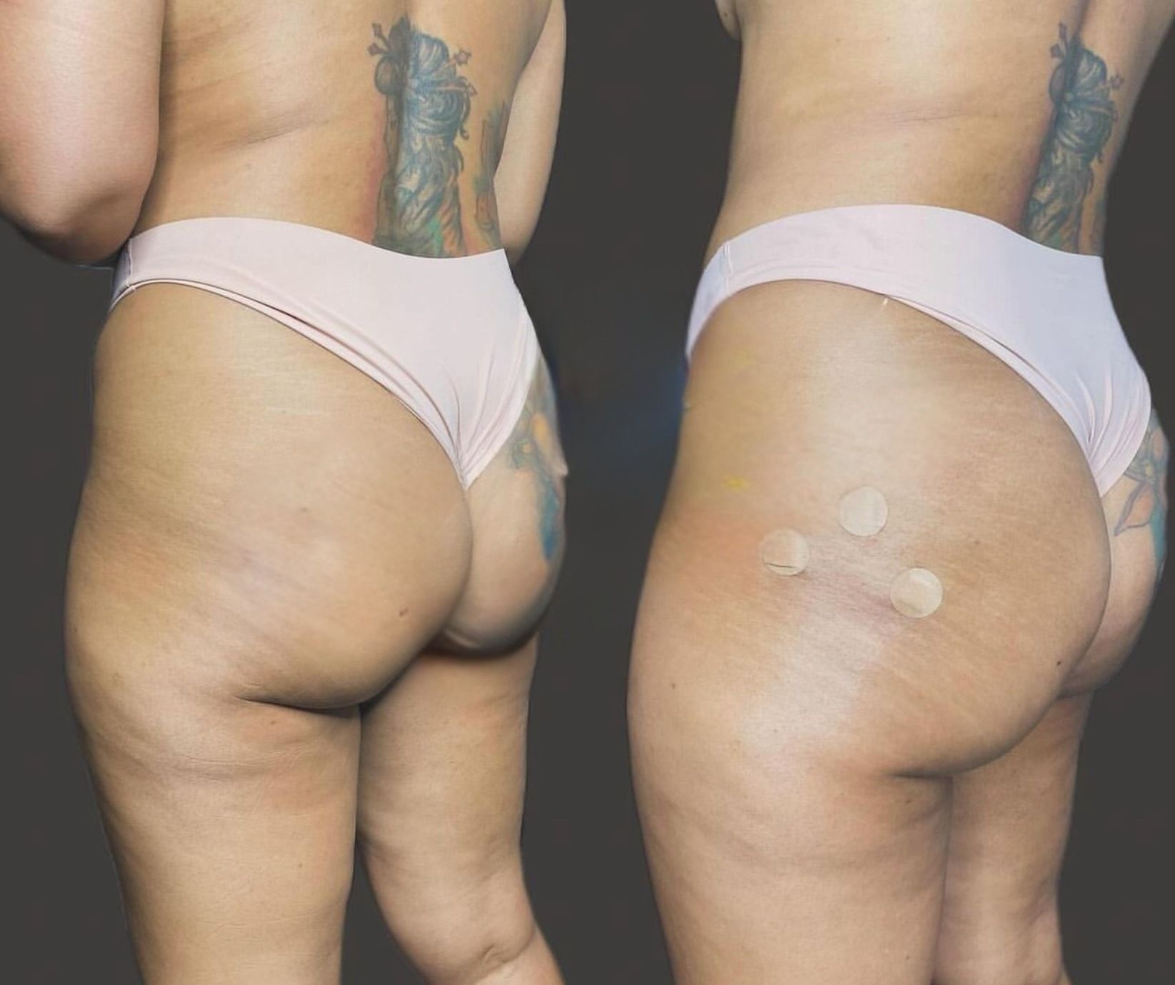 Before-and-after view of a person's buttocks after a cosmetic procedure; noticeable skin changes and marks.