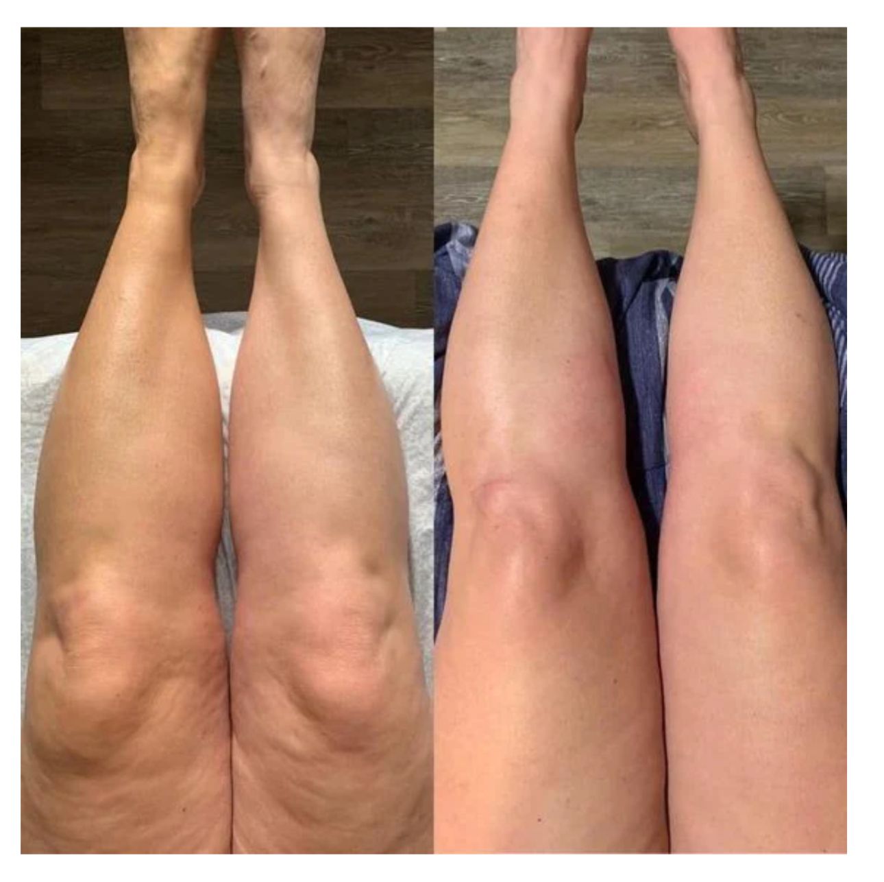 Two legs side-by-side. Left shows legs with cellulite, right shows smoother skin, possibly post-treatment.