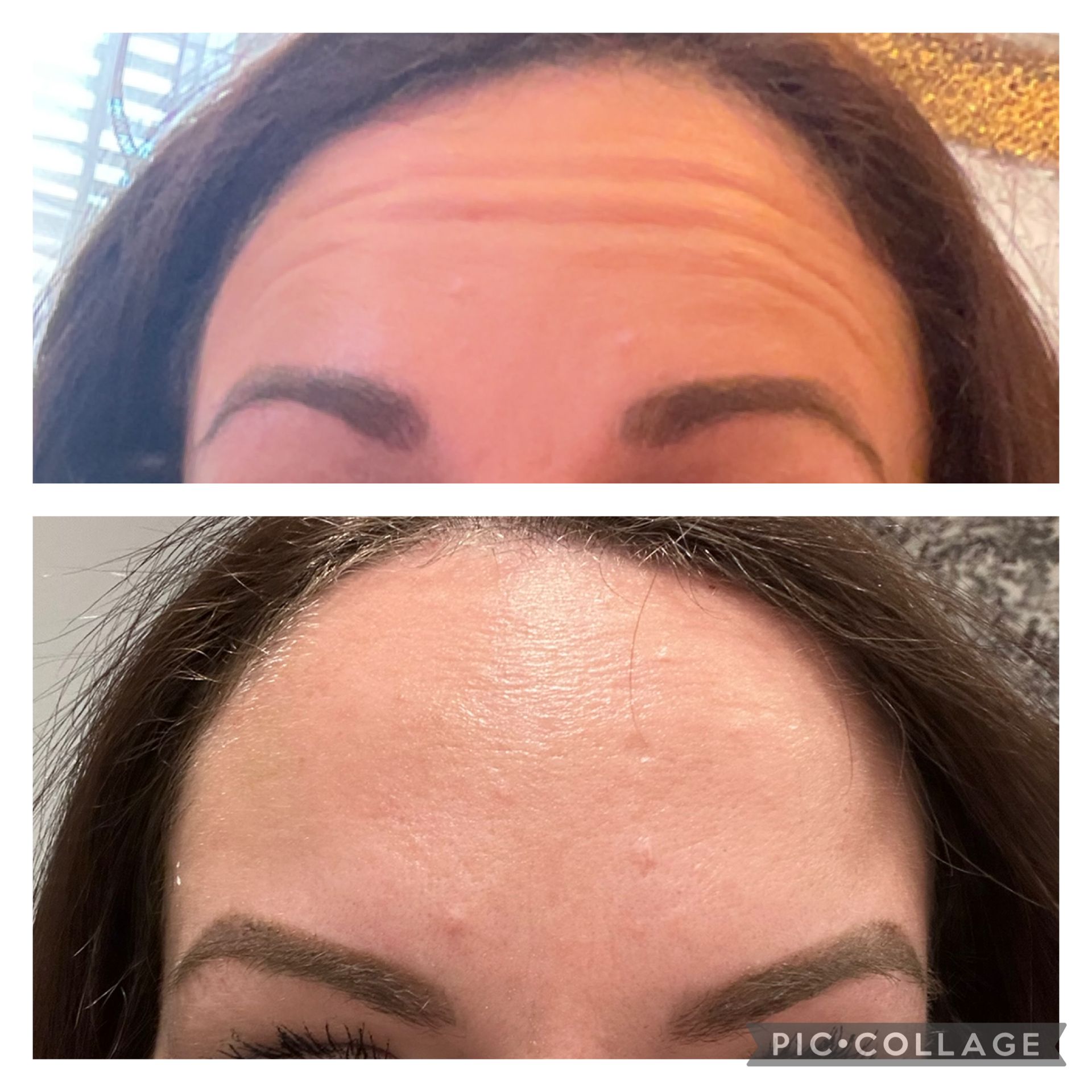 Before and after of woman's forehead. Top: visible wrinkles. Bottom: smoother skin after treatment.