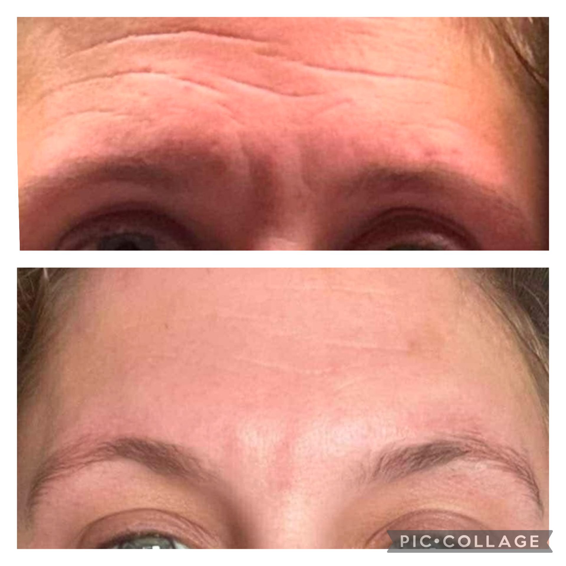 Top: Wrinkled forehead. Bottom: Smooth forehead. Comparison of before and after treatment.