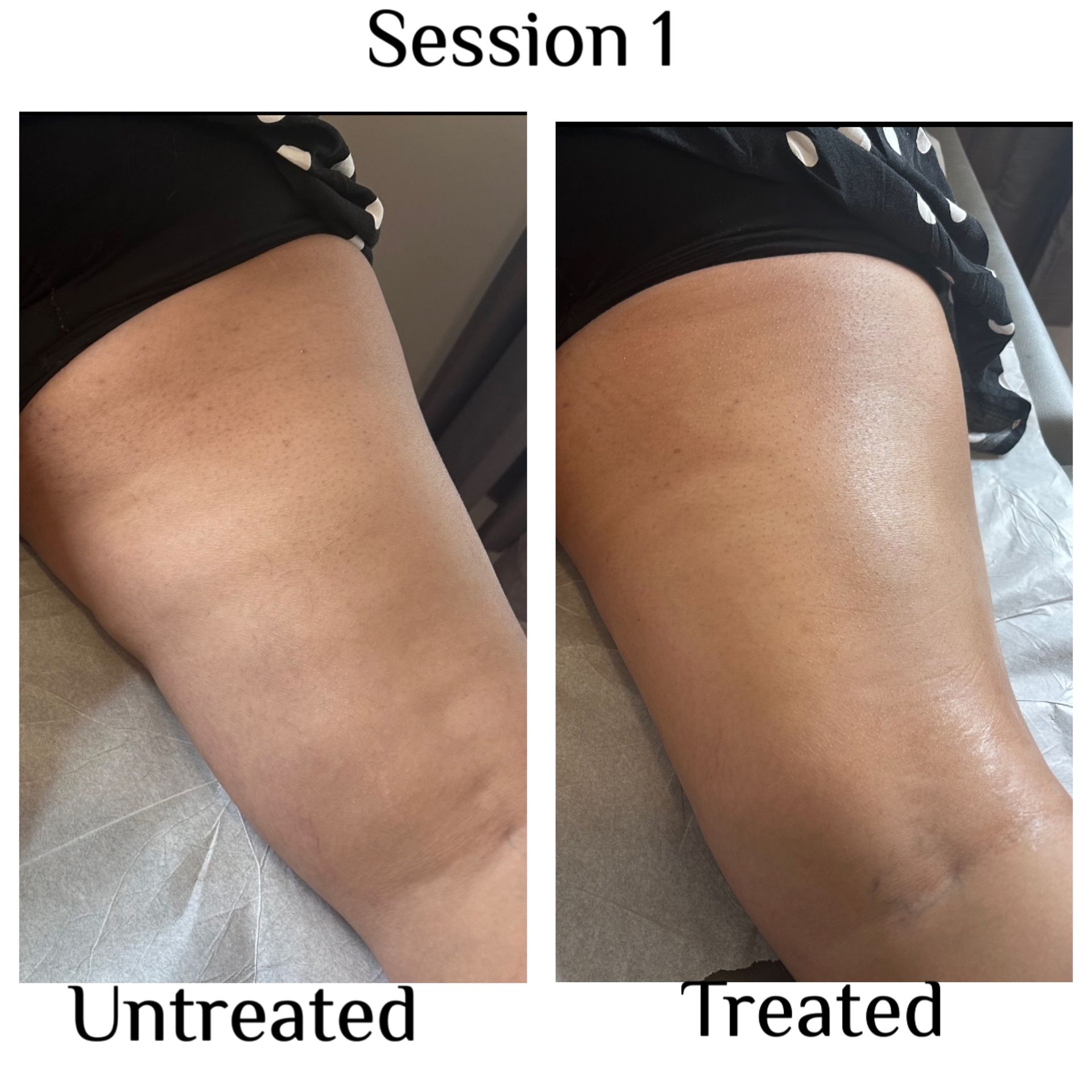 Comparison of a thigh before and after treatment, labeled “Untreated” and “Treated” in a medical setting.