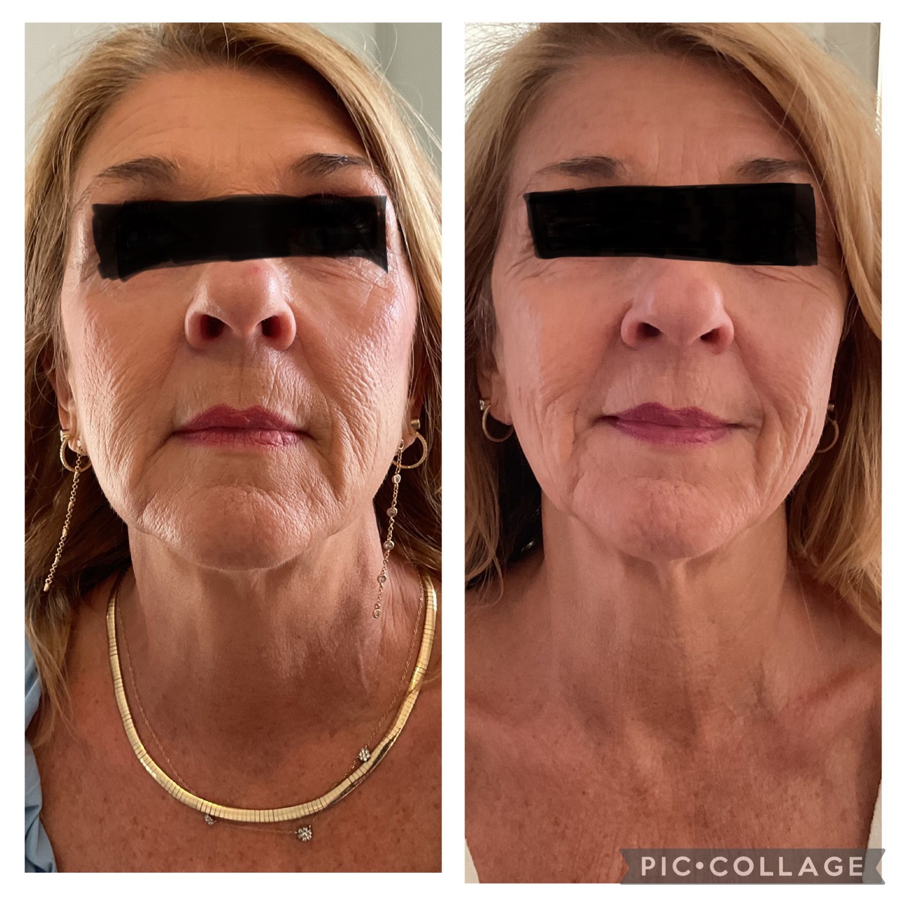 Before and after photos of a woman's face after a cosmetic procedure, with less wrinkles and a smoother appearance.