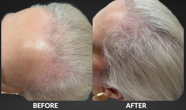 Before and after comparison of a person’s thinning scalp. The