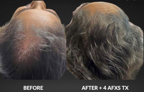 Comparison of a man's balding head