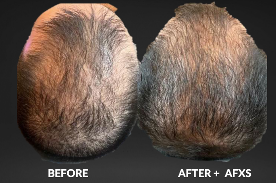 Before and after view of male scalp with hair loss, showing improved hair density after treatment with AFXS.