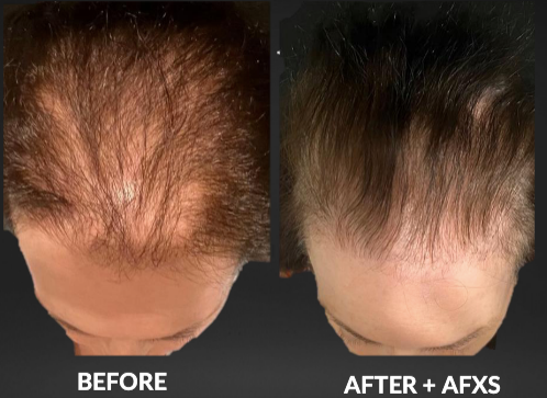 Before and after comparison of a person's scalp showing hair growth, frontal view.