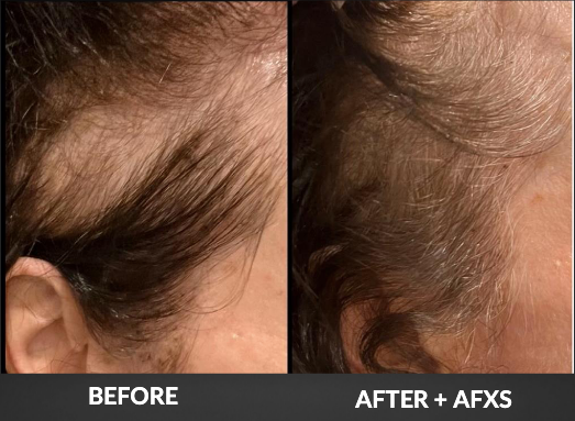 Before and after comparison of a woman's scalp, showing hair growth after using AFXS treatment.