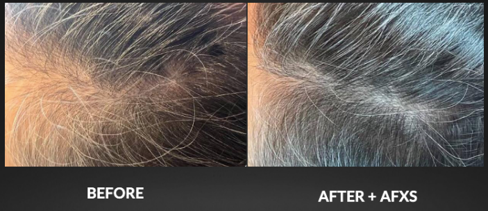 Comparison of thinning hair