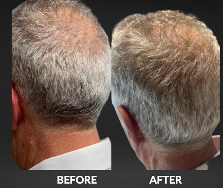 Before and after comparison of a man's scalp, showing hair growth following treatment; gray hair.