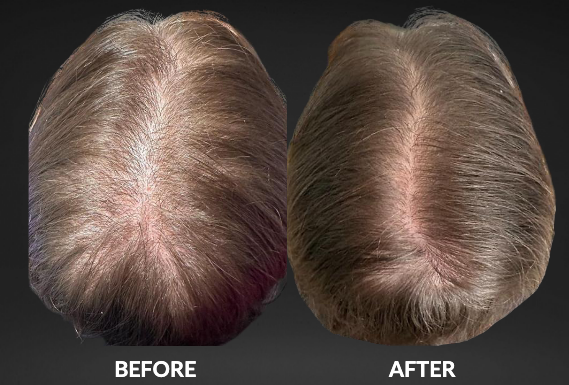 Two overhead views of a scalp, labeled