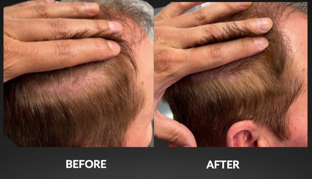 Hair restoration comparison: Before and after photos of a person's head; fuller hair in the 'after' photo.