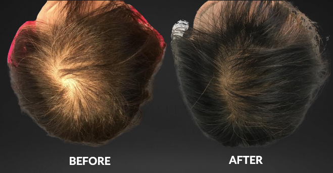 Before-and-after view of hair growth: thinning hair before, fuller dark hair after treatment.