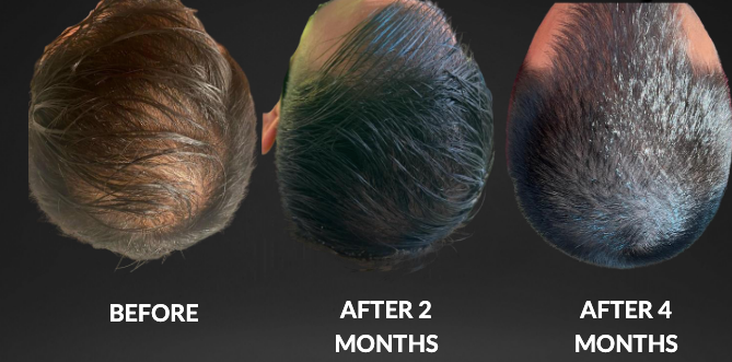 Comparison of hair growth: Before, after 2 months, and after 4 months.