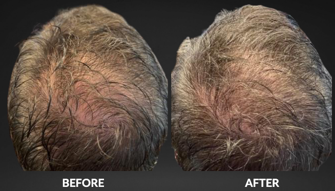Before and after comparison of a man's scalp, showing hair growth after treatment.