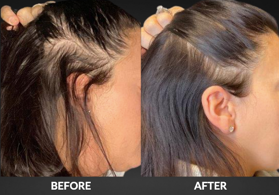 Side-by-side comparison: Woman's hairline before and after hair growth treatment. Dark hair, skin tone visible.
