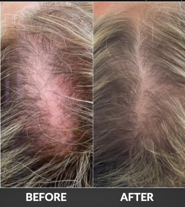 Before-and-after comparison of thinning hair, showing fuller hair growth on the right.