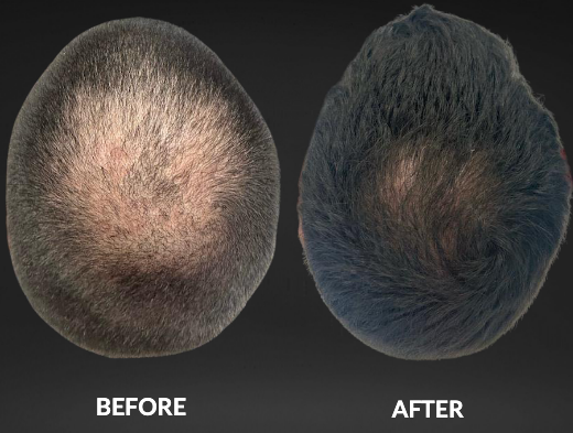 Before and after view of a man's balding head; left is balding, right has fuller hair.