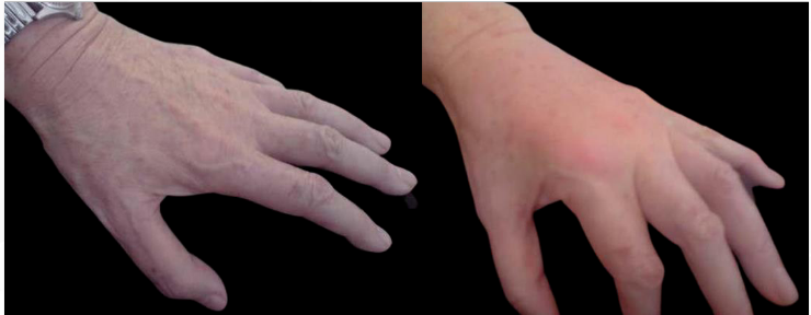 Two hands, one pale, the other pink, side-by-side on black background.